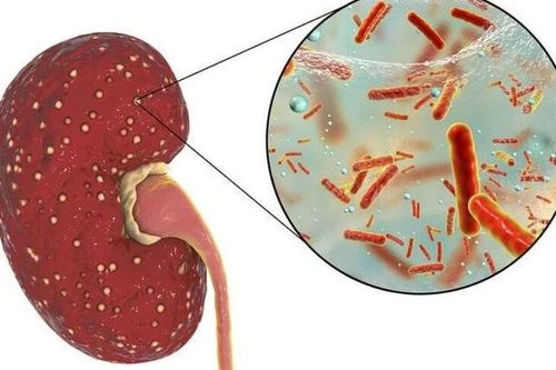 Điều trị kịp thời viêm thận, bể thận cấp trẻ em, ổ nung mủ sâu nguy hiểm