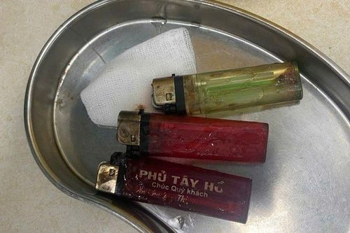 Người đàn ông nhập viện với 3 chiếc bật lửa trong dạ dày: Bác sĩ khuyến cáo điều này