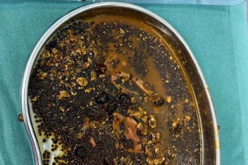 Thực hư tin đồn 'uống sữa hạt giảm cân gia tăng sỏi mật'