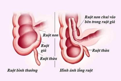 Trẻ khóc bất thường cẩn thận lồng ruột nguy hiểm