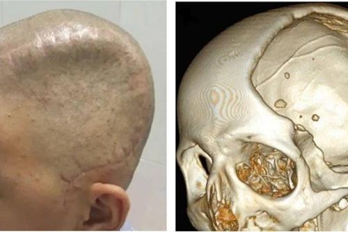Bảo vệ não bộ, phục hồi thần kinh bằng công nghệ 3D tái tạo hộp sọ