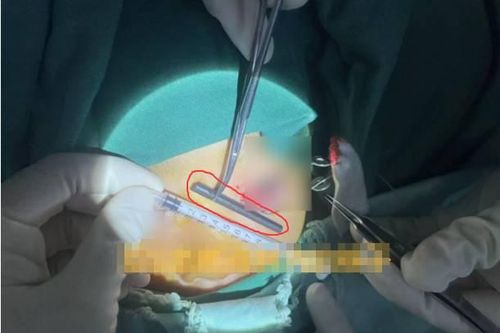 Bé trai đau mắt dữ dội, bác sĩ lấy ra thứ 'đáng sợ' bên trong