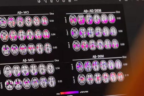 Protein gây bệnh Parkinson thúc đẩy Alzheimer tiến triển nhanh hơn ở phụ nữ