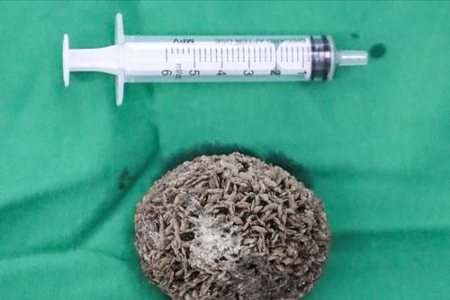 Phẫu thuật lấy sỏi bàng quang 'khủng', kích thước bằng quả trứng ngỗng