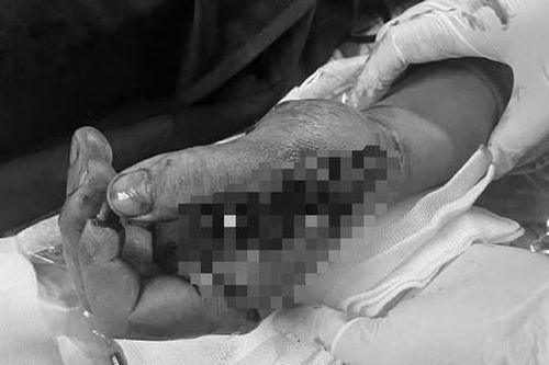 Tai nạn trong tích tắc vì pháo nổ, nam thanh niên suýt mất chức năng bàn tay