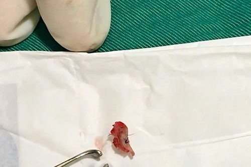 Hiếm gặp nang rò sống mũi gây viêm màng não, áp xe nội sọ