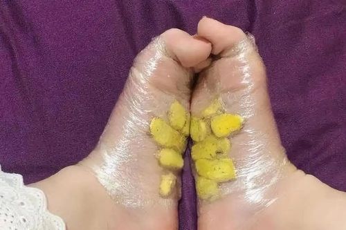 Vì sao nhiều người đắp gừng lên gan bàn chân trước khi ngủ?