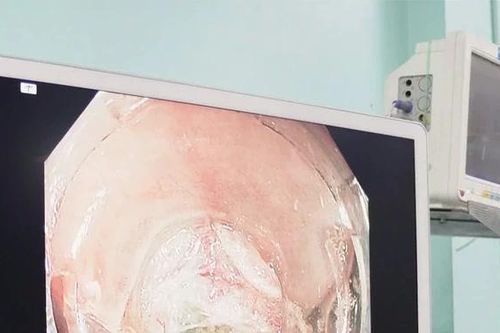 Lần đầu cắt khối u 10cm qua nội soi không cần phẫu thuật mổ mở