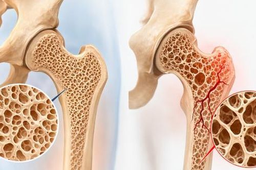 8 cách tăng mật độ xương, giảm nguy cơ loãng xương và gãy xương