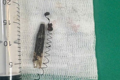 Thanh niên 29 tuổi bị đầu bút, lò xo găm trong thái dương suốt 13 năm