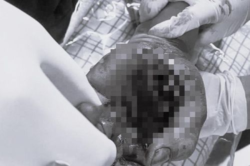 Pháo phát nổ ngay trên tay, nam thanh niên nhập viện với bàn tay dập nát