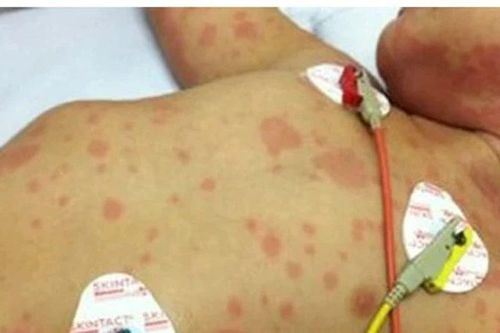 Không để dịch bệnh viêm màng não mô cầu lan rộng tại cộng đồng