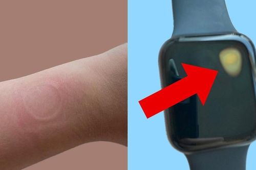 Apple Watch bị nghi quá nhiệt gây bỏng, Apple chưa lên tiếng sau 6 tháng