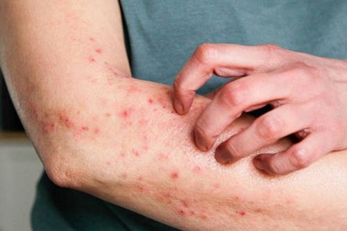 Bộ Y tế yêu cầu không để dịch bệnh viêm màng não mô cầu lan rộng tại cộng đồng