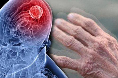 Nam và nữ mắc Parkinson biểu hiện sớm khác nhau ra sao?