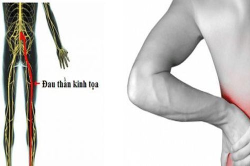 Vitamin và khoáng chất nào tốt cho người đau thần kinh tọa?
