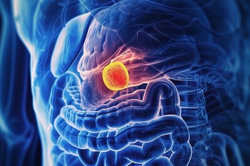 5 triệu chứng cảnh báo ung thư tuyến tụy