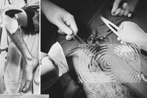 Hướng dẫn xử lý tai nạn lao động đúng cách để bảo vệ chi thể