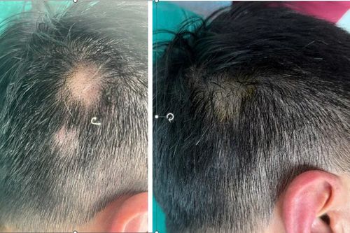 Tóc rụng từng mảng, bác sĩ mách cách chữa hiệu quả