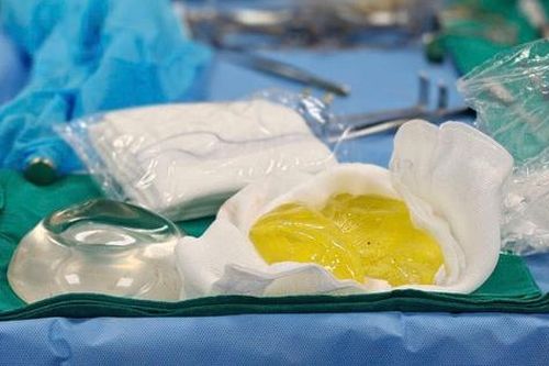 Người phụ nữ tá hỏa vì túi ngực vỡ vụn sau 5 năm dù không có cảm giác đau