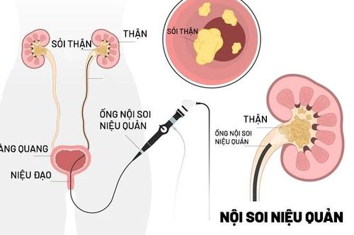 Bác sĩ nêu rõ chỉ định tán sỏi nội soi ngược dòng bằng ống mềm
