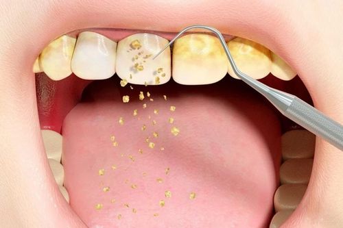 Tại sao cần lấy cao răng định kỳ và những dấu hiệu cảnh báo bạn không nên bỏ qua