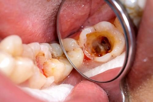 5 biện pháp tự nhiên giảm triệu chứng sâu răng