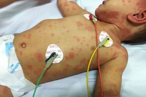 Bệnh viêm não mô cầu gia tăng: giám sát chặt chẽ, hạn chế lây lan