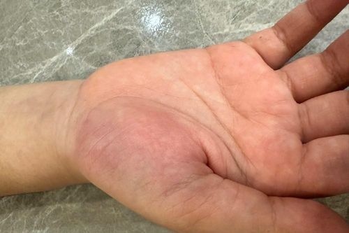 Bệnh viện chứng nhận thương tích của học sinh lớp 4 bị cô giáo đánh vào tay