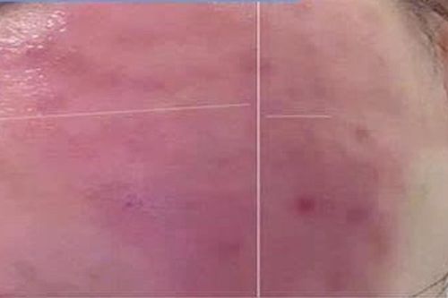 Tiêm meso tại nhà, người phụ nữ nhập viện vì biến chứng nặng