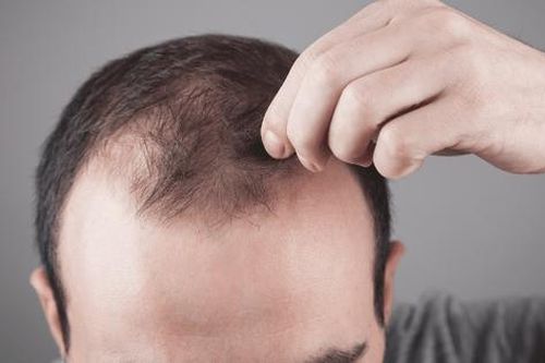 5 loại dầu dưỡng tự nhiên tốt nhất cho nam giới bị hói đầu