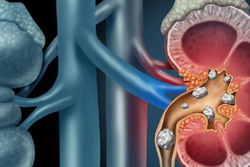 Sỏi san hô nguy hiểm nhận biết ra sao?