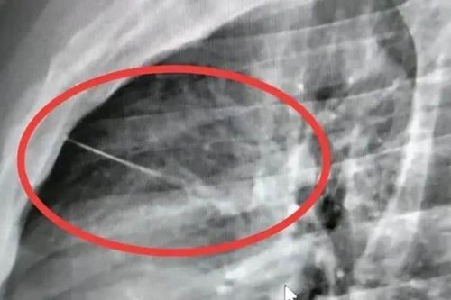Tưởng chỉ là cơn đau ngực bình thường, người đàn ông sốc khi biết có dị vật nằm sát tim: Bác sĩ phải phẫu thuật khẩn cấp