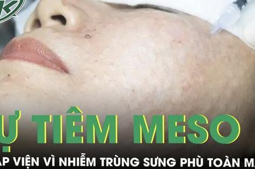 Tự tiêm meso tại nhà, người phụ nữ nhập viện vì nhiễm trùng sưng phù toàn mặt