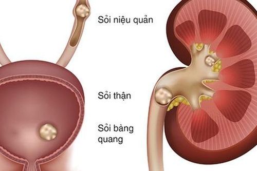 5 nguyên nhân làm tăng nguy cơ sỏi niệu quản và cách phòng ngừa hiệu quả