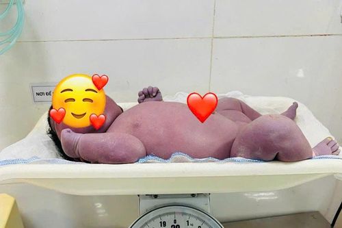 Ca sinh đặc biệt: Bé trai nặng 5,4kg chào đời an toàn trên nền sẹo mổ cũ