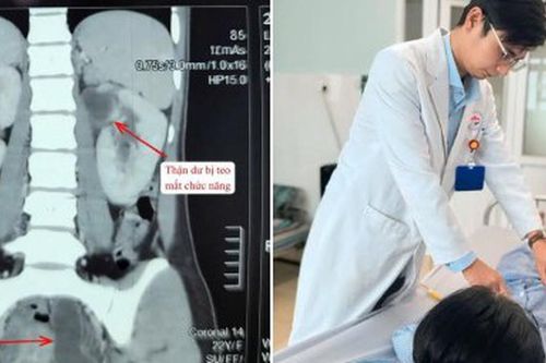 Cô gái 22 tuổi mất chức năng thận vì dị tật hiếm, bác sĩ cảnh báo dấu hiệu dễ bỏ qua