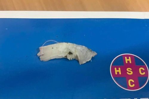 Người đàn ông 63 tuổi suýt gặp biến chứng nguy hiểm vì mảnh xương cá dài 4cm