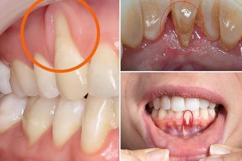 Tụt lợi có thực sự nguy hiểm?