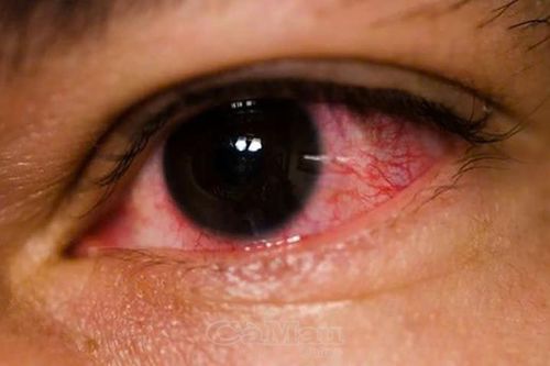 Những lưu ý về bệnh đau mắt đỏ
