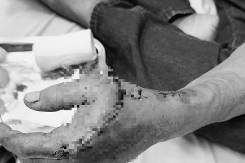Sử dụng cưa máy, người đàn ông bị lưỡi cưa cắt gãy xương, đứt gân