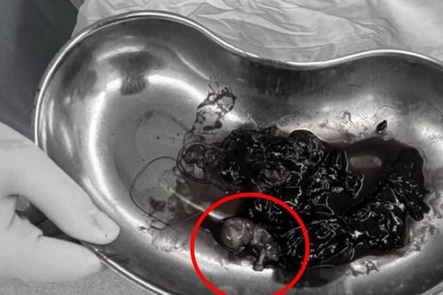 Cứu sống ngoạn mục bệnh nhân mang thai trong ổ bụng ở vị trí cực kỳ hiếm gặp