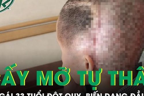 Cấy mỡ tự thân, cô gái 33 tuổi đột quỵ, biến dạng đầu
