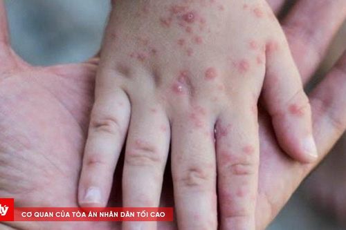 Siết kiểm soát tay chân miệng, chủ động ứng phó từ cơ sở