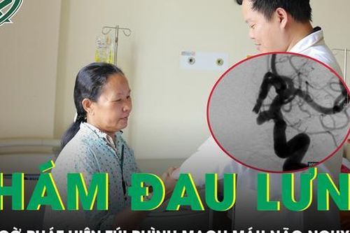 Đi khám đau lưng, người phụ nữ bất ngờ phát hiện túi phình mạch máu não nguy hiểm