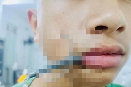 Nghệ An: Kịp thời cứu bé trai bị lưỡi câu cắm sâu vùng mặt