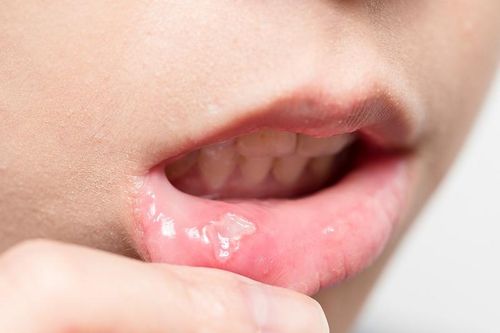 5 món tưởng như vô hại âm thầm 'kích hoạt' ung thư miệng