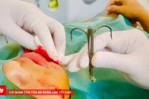 Lưỡi câu móc sâu vào mặt nam sinh 15 tuổi ở Nghệ An