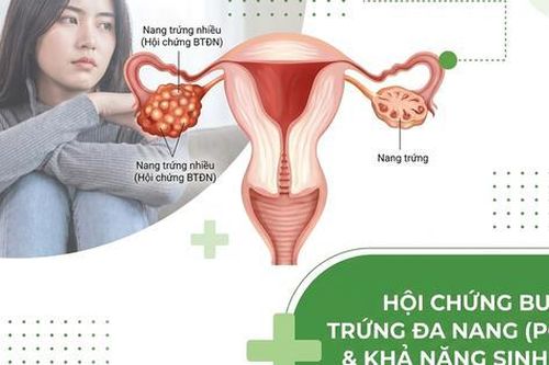 4 cách cải thiện khả năng sinh sản ở phụ nữ mắc Hội chứng buồng trứng đa nang