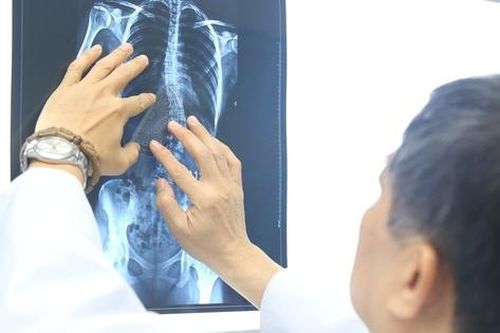 Nhiều trẻ chỉ được phát hiện bệnh khi cột sống đã cong vẹo, chuyên gia khuyến cáo gì đến phụ huynh?